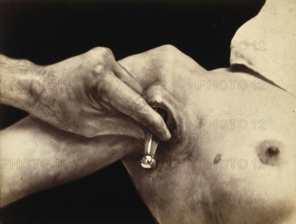 Patient, operation, a surgical instrument made of metal is inserted in an incision in the armpit, medicine, medical history, photography, turn of the century, around 1900, historical