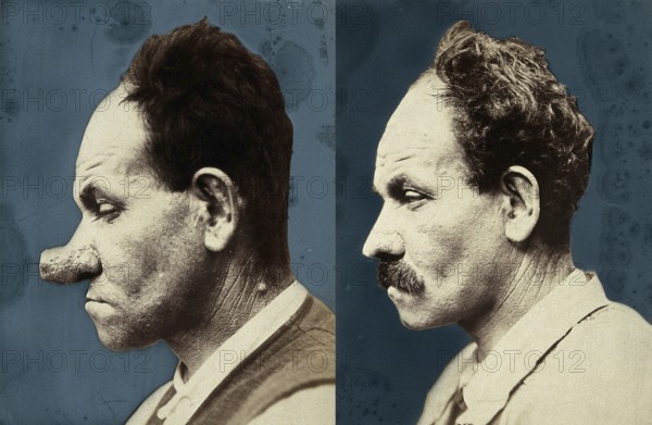Cosmetic surgery, cosmetic surgery in front of, after. A man with a large, deformed nose who was diagnosed as a result of hypertrophic acne, in profile. Por and after the operation. medicine, history of medicine, photography, turn of the century around 1900, France, historical