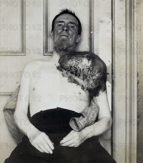 Bone cancer, malignant tumor, sarcoma, man with a large periosteal sarcoma, that from his shoulder. medicine, history of medicine, photography, around 1920, historical