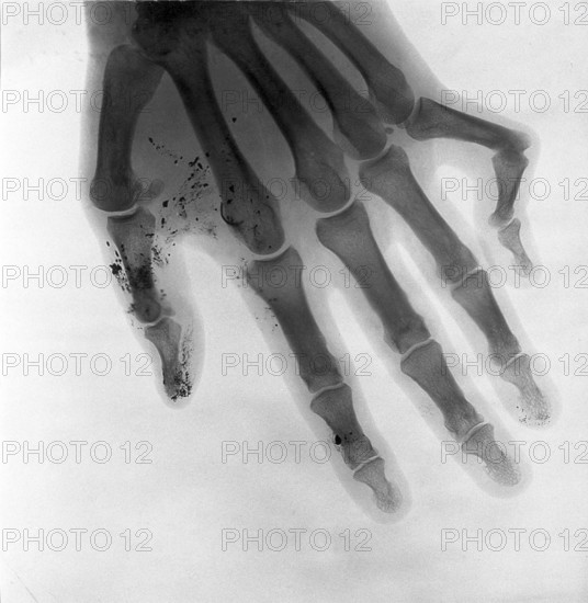Bone of a hand, deformed little finger, fracture of the joint, X-ray, X-ray, around 1900 medicine, medical history, photography, historical