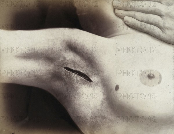 Patient, operation, an cut in the armpit to operation silverware, medicine, history of medicine, photography, turn of the century, around 1900, historical