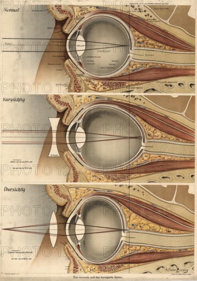 Medical illustration, defective vision of the human eye, school picture, authentic reproduction of a school mural, around 1900, exact date unknown, historical