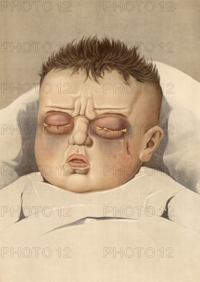 Medical illustration, clinical picture, venereal disease, tripper eye, symptoms of gonorrhea in the eye, gonococcal conjunctivitis, severe reddening of the conjunctiva, swollen eyelids, school picture, authentic reproduction of a school mural, around 1900, exact date unknown, historical