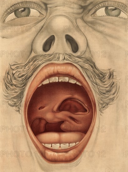 Medical illustration, clinical picture, venereal disease, palate perforation caused by syphilis, perforation, late stage tertiary syphilis, from destructive inflammation, school picture, authentic reproduction of a school mural, around 1900, exact date unknown, historical