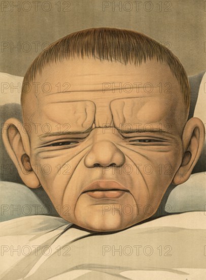 Medical illustration, clinical picture, venereal disease, syphilis, hereditary syphilis, child with senile face, congenital syphilis, a sexually transmitted disease caused by the bacterium Treponema pallidum, school picture, authentic reproduction of a school mural, around 1900, exact date unknown, historical