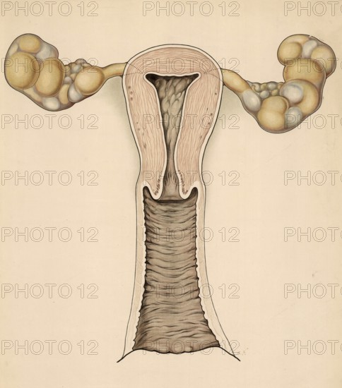 Medical illustration, clinical picture, venereal disease, gonorrhea, female reproductive organs altered by gonorrhea, cervicitis, uterus, endometritis, fallopian tubes, salpingitis and ovaries, oophoritis, school picture, authentic reproduction of a school mural, around 1900, exact date unknown, historical