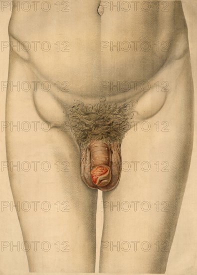 Medical illustration, clinical picture, venereal disease, primary affect of syphilis on the male genitals, hard ulcer, durum ulcer or hard chancre that forms at the point of entry of the bacterium, usually on the penis or foreskin, school picture, authentic reproduction of a school mural, around 1900, exact date unknown, historical