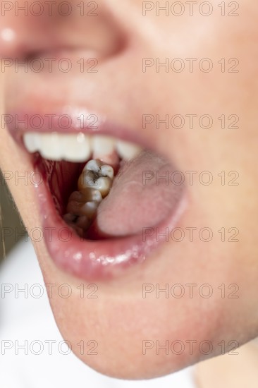 Woman with her mouth open shows a visible amalgam filling on her molar during a dental examination in a dental practice in Germany