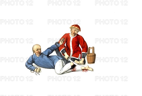 Jurisprudence, torture and punishment in medieval China, a criminal's legs are cut off. This punishment is said to have been imposed on wrongdoers who tried to flee. A vessel with chunam, a type of mortar, is ready to be applied to wounds as a hemostatic agent, authentic, digitally restored reproduction from an 18th century model, exact date of depiction unknown, historical