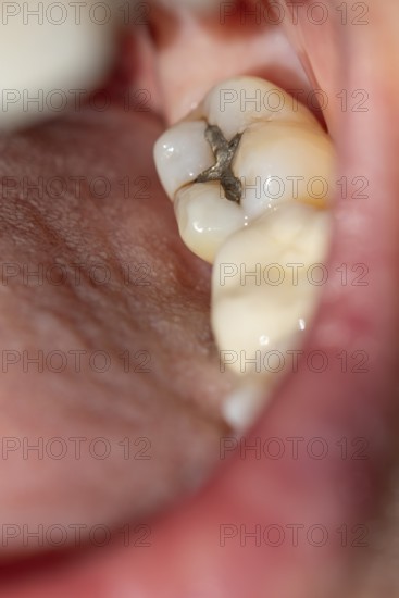 Woman with her mouth open shows a visible amalgam filling on her molar during a dental examination in a dental practice in Germany