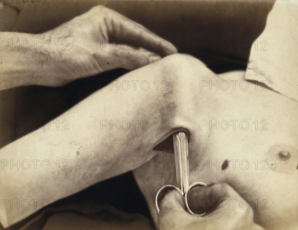 Patient, operation, a surgical instrument made of metal is inserted in an incision in the armpit, medicine, medical history, photography, turn of the century, around 1900, historical