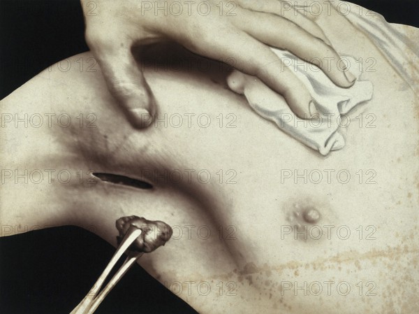 Patient, surgery, breast surgery, lump removal, tumor, metal surgical instrument inserted through an incision in the armpit. medicine, history of medicine, photography, turn of the century around 1900, historical