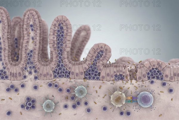 Microscopic cross-section of the small intestinal mucosa in coeliac disease: inflammatory cells react to undigested gluten peptides, which leads to flattening and damage to the sensitive intestinal villi. Dermatology, cosmetic research, anti-ageing, gastroenterology, microbiome research, AI generated