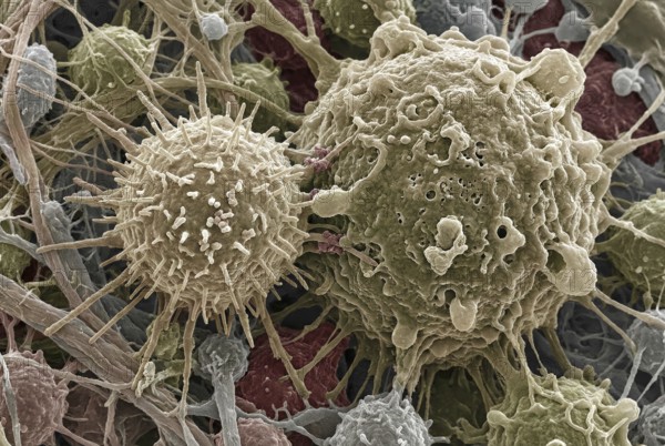 Macro-visualization of a CAR-T immune cell that binds to a tumor cell with cell membranes and tumor microenvironment, generates AI, AI generated