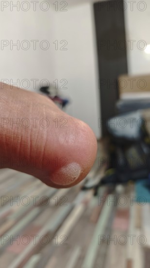 Hiking, tight shoes, close-up of a painful, large blister on the heel with skin detail in focus, blurred background