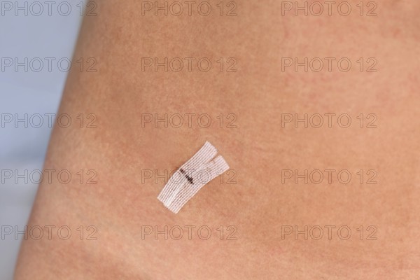 Sterile wound closure strip used on cut after laparoscopy on woman's lower abdomen