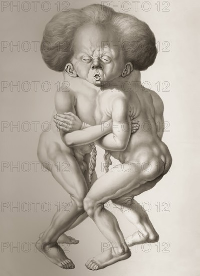 Twins conjoined at the head and thorax, drawing c 1830, digitally edited
