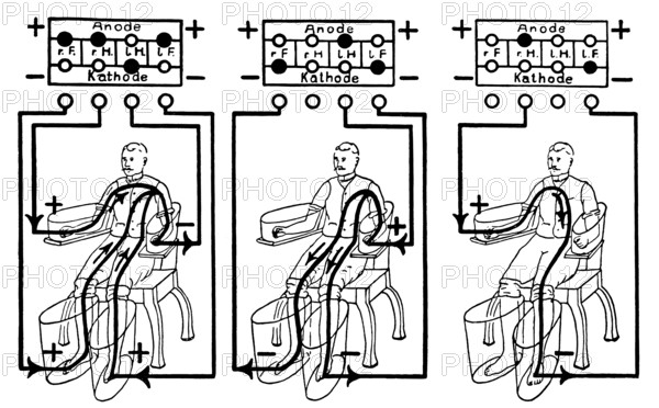 An illustration of a patient being treated with a four cell Schnee Bath, an early electric medical equipment for treating rheumatism