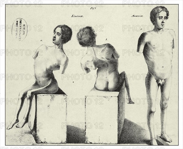 Enfants paraplégiques