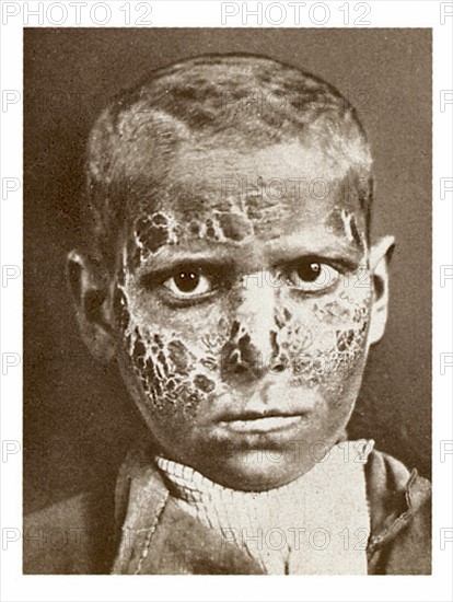 A young victim of pellagra