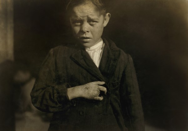 Giles Edmund Newsom, Young Cotton Mill Worker, 12 years old, Fell on to Spinning Machine and his hand went to into unprotected gearing, losing two fingers, Half-length Portrait, Sanders Spinning Mill, Bessemer City, North Carolina, USA, Lewis Hine for National Child Labor Committee, October 1912