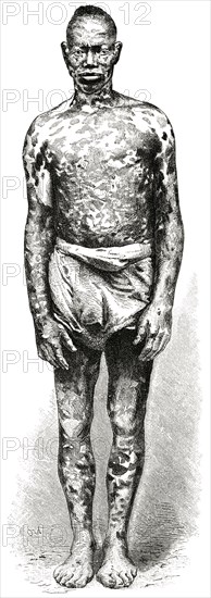 Man with Mottled Skin, Loango Coast, Africa, Illustration, 1885