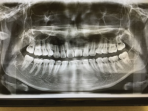 Dental X-Ray of Teen Girl,,