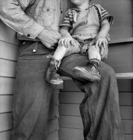 Young Child with Clubfeet wearing Homemade Splints inside Shoes, Farm Security Administration Camp for Migratory Workers