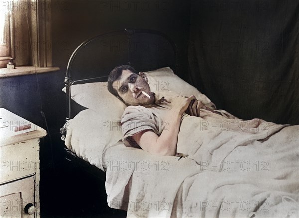 Wounded American soldier enjoying cigarette in hospital