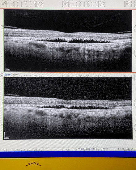 OCT scan (Optical Coherence Tomography) of human retina, both eyes