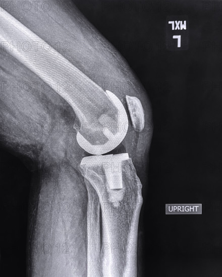 X-ray of adult man's knee after knee replacement surgery