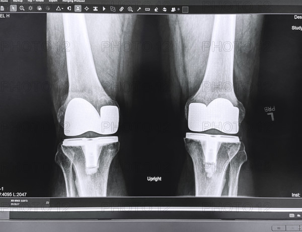 X-ray of adult man's knees after knee replacement surgery