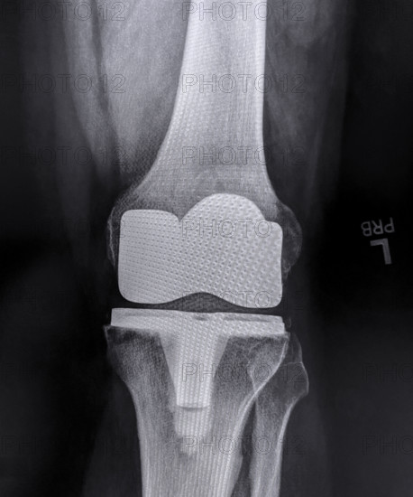 X-ray of adult man's left knee after knee replacement surgery