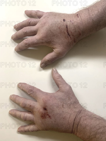 Cat scratches on man's hands