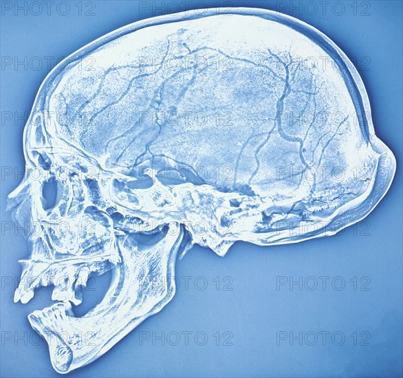 Xeroradiograph of the bathrocranic skull. Artist: Unknown