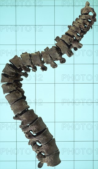 Spinal column showing the curvature of the spine. Artist: Unknown