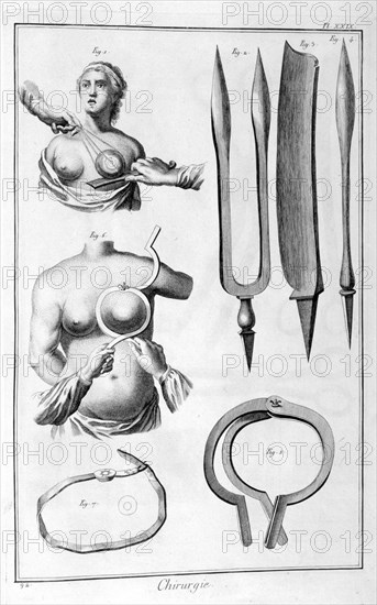 Breast surgery, 1751-1777. Artist: Unknown