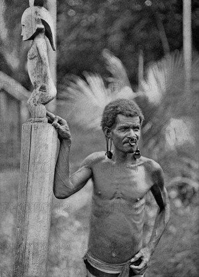Malformation of the ears, Solomon Islands, 1920.Artist: JW Beattie