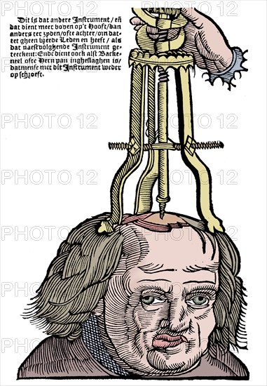 Trephination, 1593. Artist: Unknown.