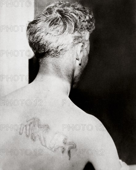 The branded back of Reverend Orrin Van Loon, Detroit, Michigan, USA, July 1924. Artist: Unknown