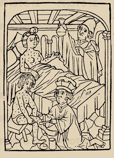 Syphilis treatment: Treatment with ointments (mercury). From: A Malafranczos morbo gallorum preserv