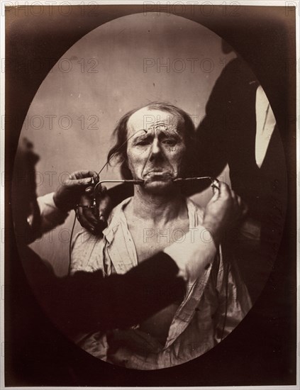 Figure 45: Contraction électrique forte des triangulaires des lèvres et des sourciliers:..., c. 1856 Creator: Guillaume-Benjamin-Amand Duchenne (de Boulogne) (French, 1806-1875); Adrien Tournachon (French, 1825-1903).