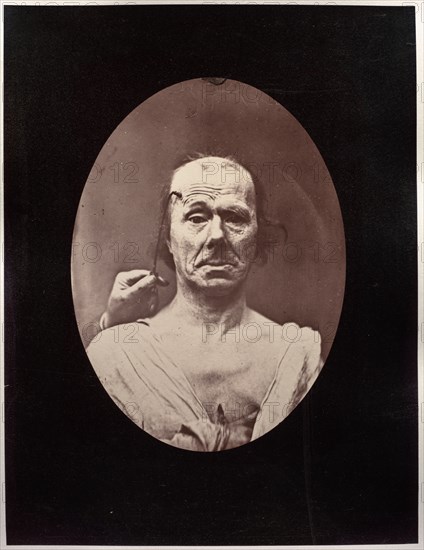 Figure 7: Étude du méchanisme et de lexpression du muscle frontal chez un vieillard: à droit..., c. Creator: Guillaume-Benjamin-Amand Duchenne (de Boulogne) (French, 1806-1875); Adrien Tournachon (French, 1825-1903).