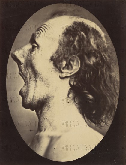 Figure 55: Astonishment badly rendered by the subject: a ridiculous and inane expression. , 1854-56, printed 1862.