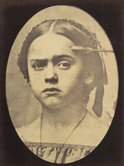 Figure 10: Showing the expressive lines of m. frontalis in a young girl , 1854-56, printed 1862.