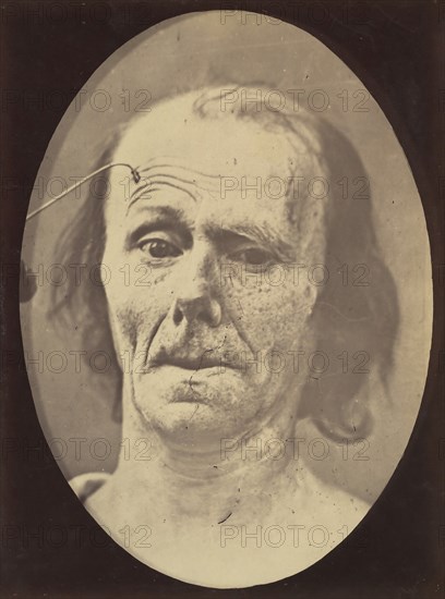 Figure 9: A study of m. frontalis in maximum contraction, 1854-56, printed 1862.