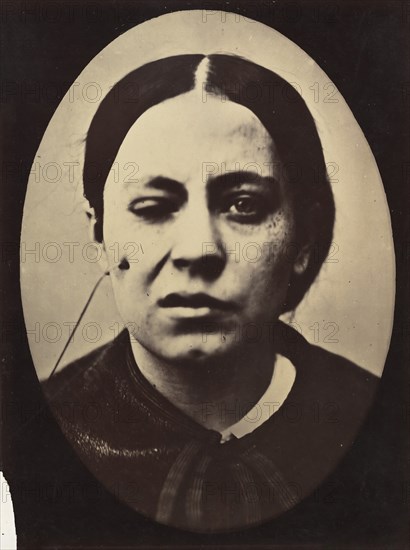 Figure 50: Affected weeping and face in repose, 1854-56, printed 1862.
