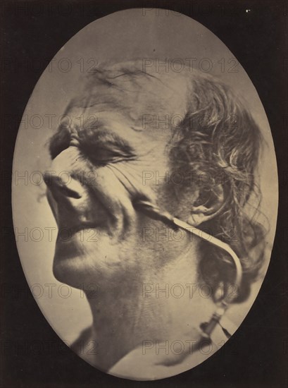 Figure 6: The grimace produced is similar to a tic of the face , 1854-56, printed 1862.