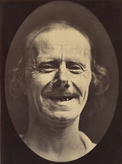 Figure 52: Voluntary retraction of the lower lip, 1854-56, printed 1862.