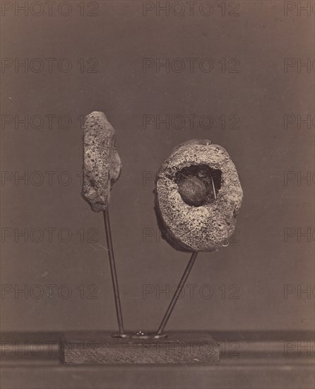 Excised Knee Joint. A Round Musket Ball in the Inner Condyle of the Right Femur [Gardiner Lewis, Company B, Nineteenth Indiana Volunteers], 1866-67.